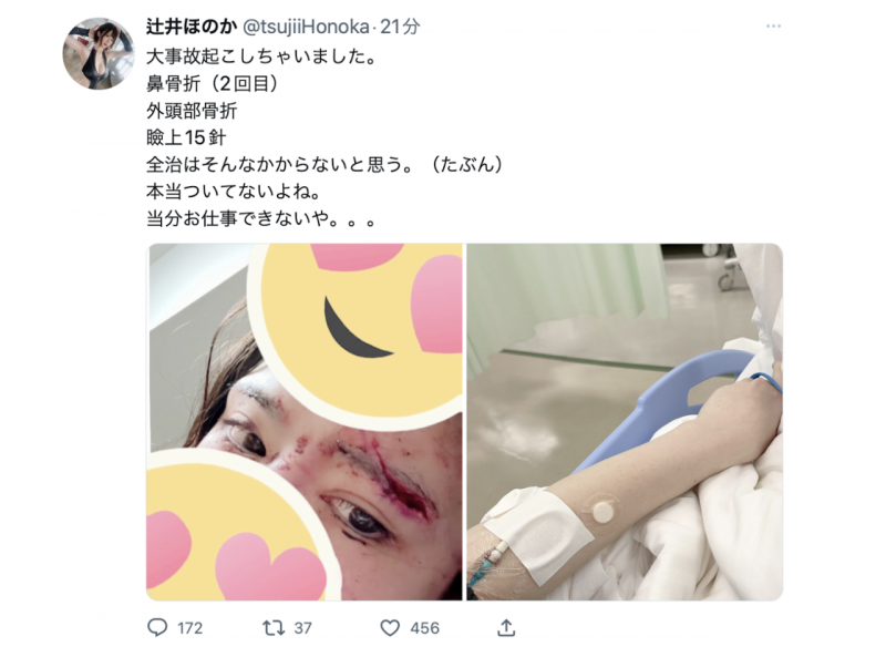 鼻子骨折眼皮缝了15针!辻井ほのか(辻井穗乃果)重伤破相!